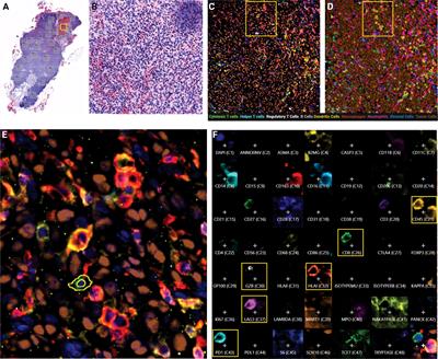 Quantitative spatial evaluation of tumor-immune interactions in the immunotherapy setting of metastatic melanoma lymph nodes